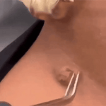 Dile adios a las verrugas   $27.99  con VerruCler envio gratis